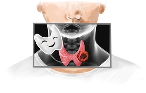 ‘선’한 가면을 쓴 갑상‘선’ 암… 착한 암이라고 미루다간 ‘위험’