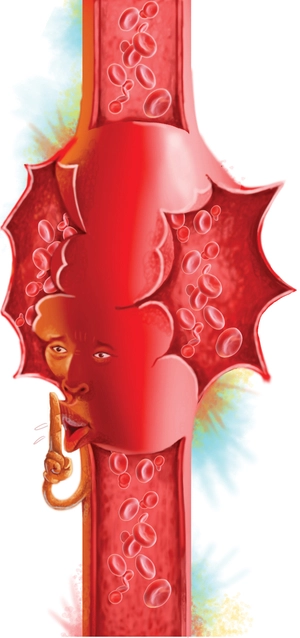 터지고 찢기는 혈관의 수난, 경고도 없다