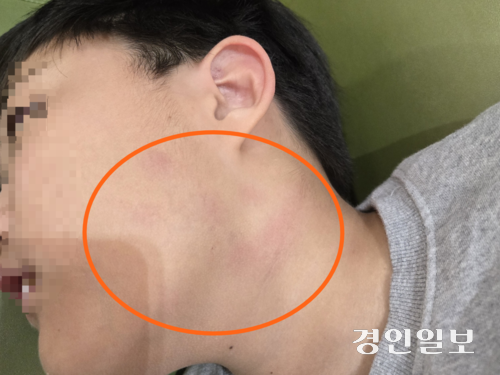 포천 한 초등학교에서 교사에게 상해 피해를 입은 B군의 턱과 목 쪽이 퍼렇게 부어 있다. /B군 가족 제공