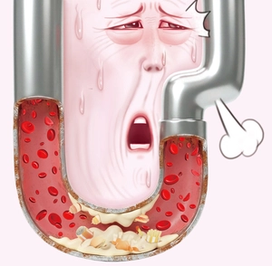 숨 막히는 세월의 흔적 ‘대동맥판막협착증’